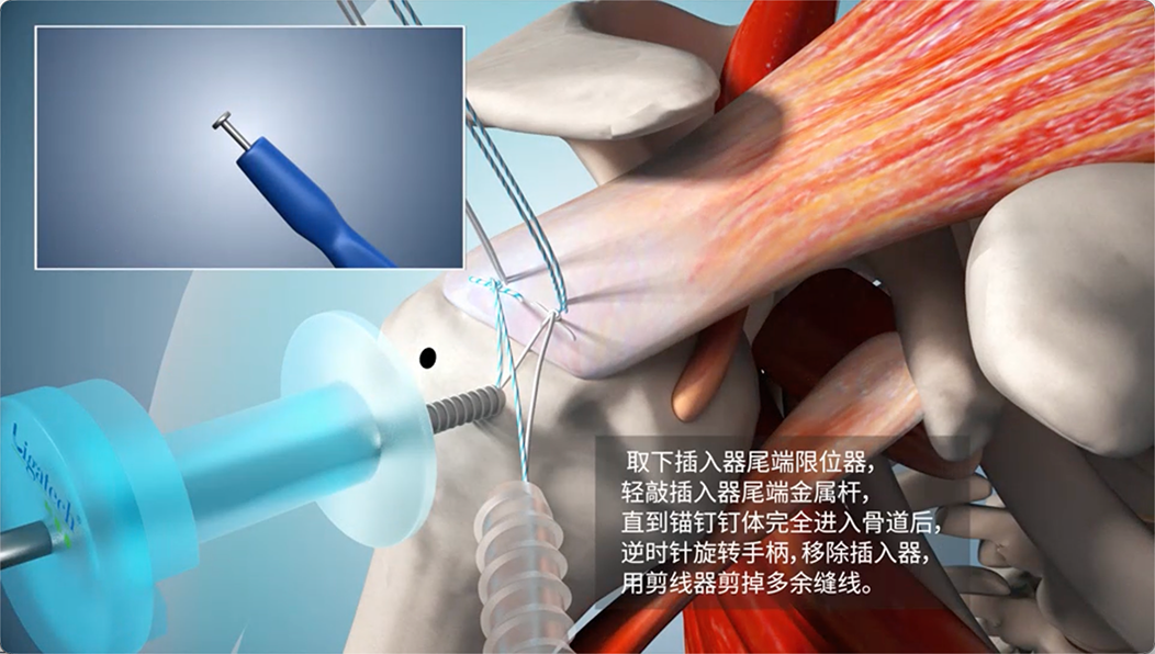 取下插入器尾端限位器，轻敲插入器尾端金属杆，直到锚钉钉体完全进入骨道后，逆时针旋转手柄，移除插入器，用剪线器剪掉多余缝线。