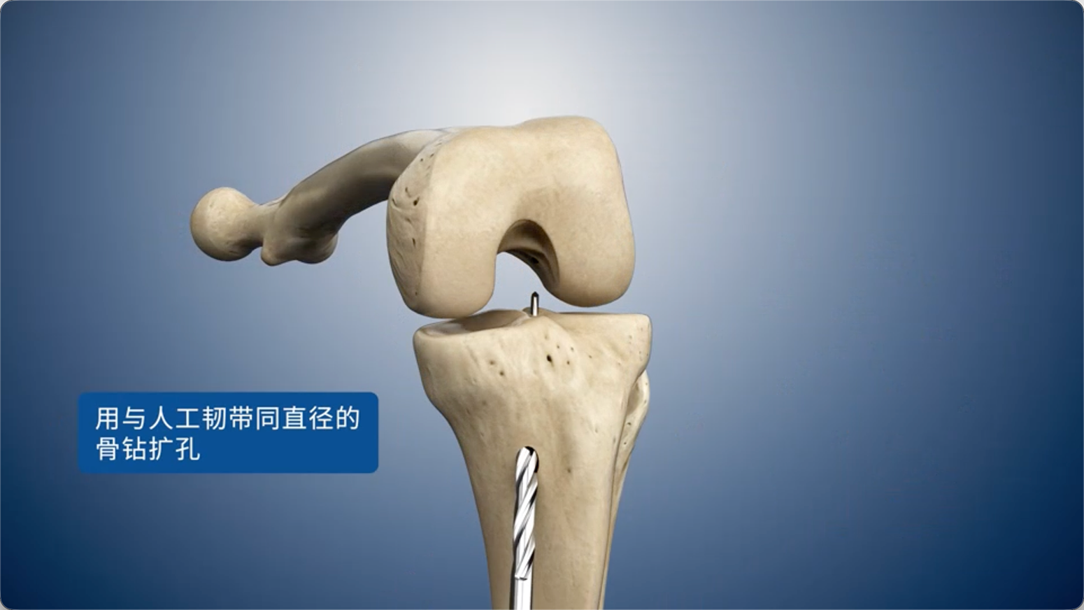 用与人工韧带同直径的骨钻扩孔