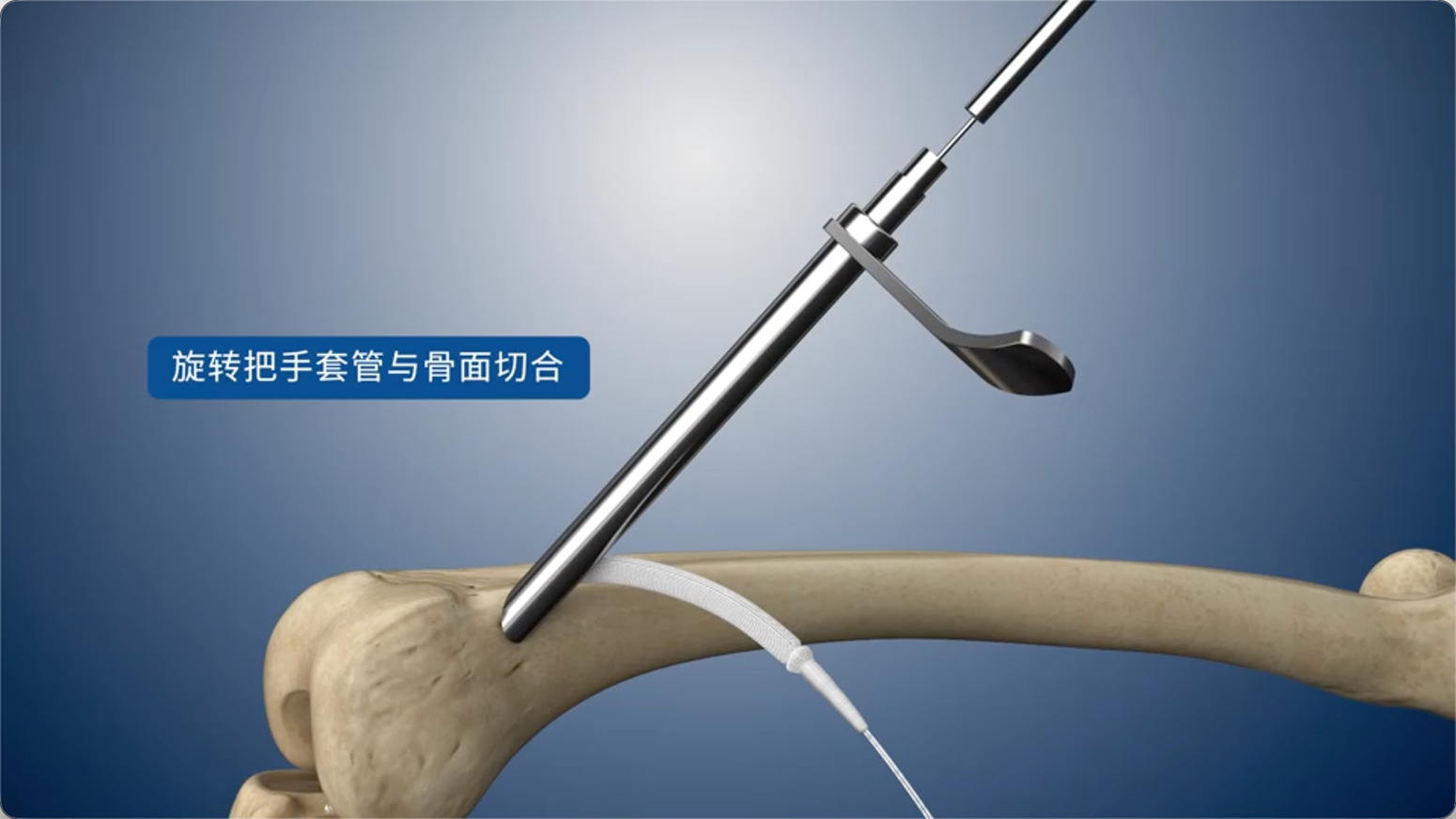 旋转把手套管与骨面切合