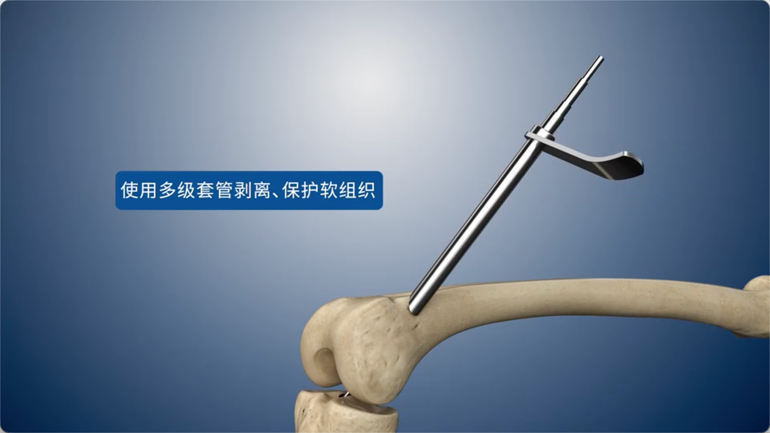 使用多级套管剥离、保护软组织