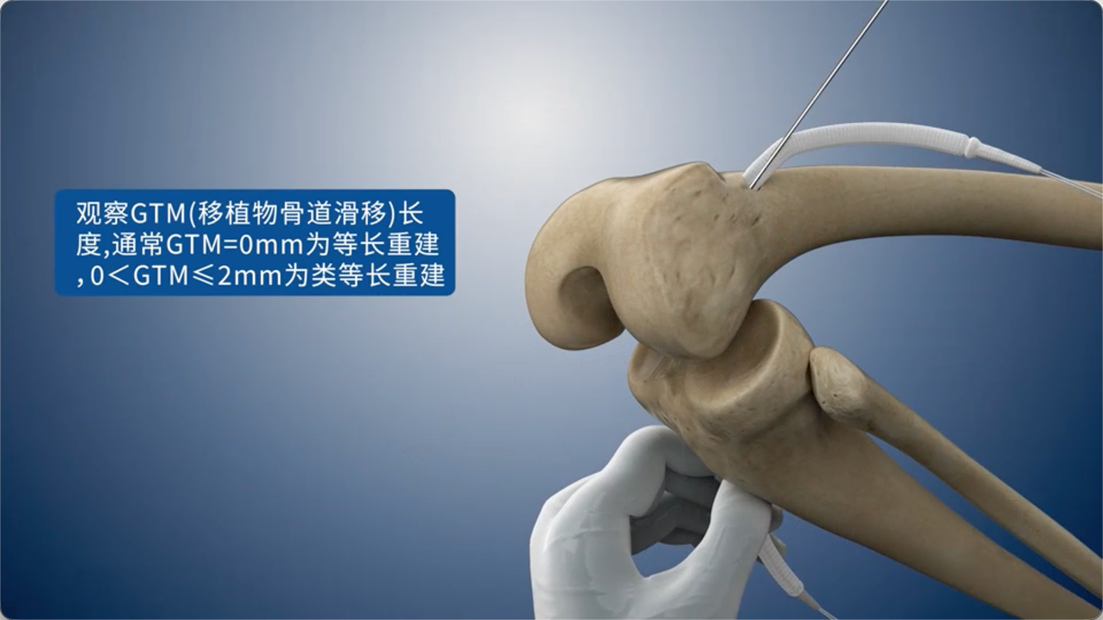 若GTM>2mm可在韧带位移最大的角度固定胫骨侧螺钉