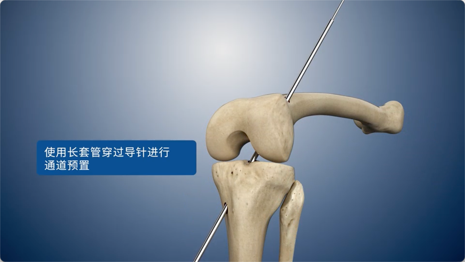 使用长套管穿过导针进行通道预置