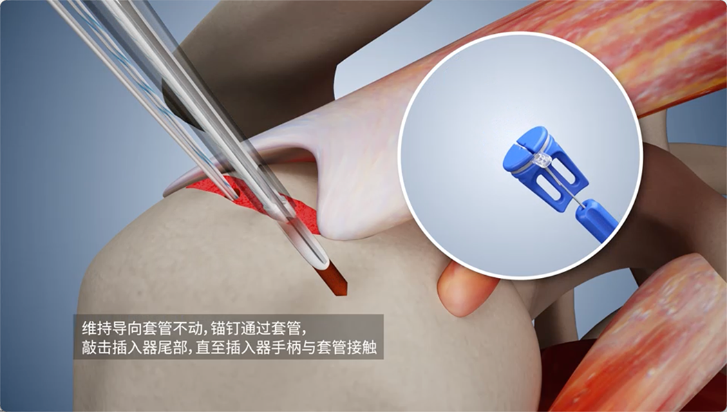 维持导向套管不动，锚钉通过套管，敲击插入器尾部，直至插入器手柄与套管接触