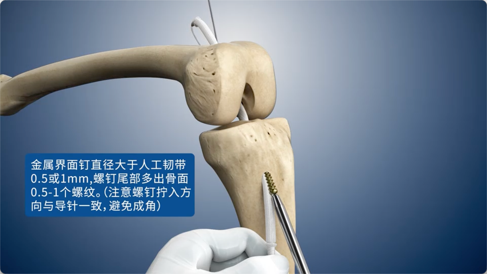金属界面钉直径大于人工韧带
0.5或1mm，螺钉尾部多出骨面0.5-1个螺纹。（注意螺钉拧入方向与导针一致，避免成角）