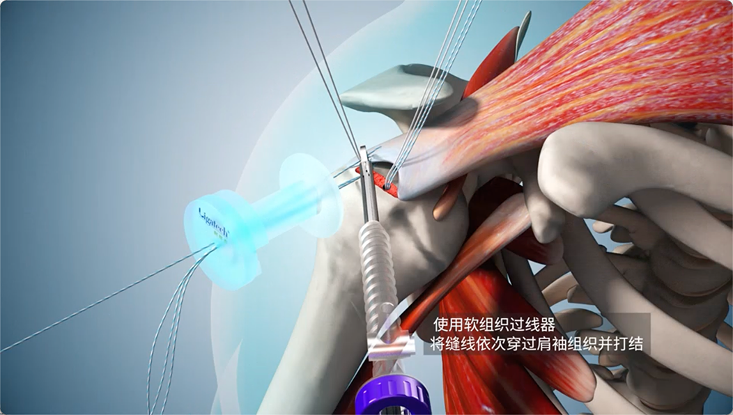 使用软组织过线器，将缝线依次穿过肩袖组织并打结