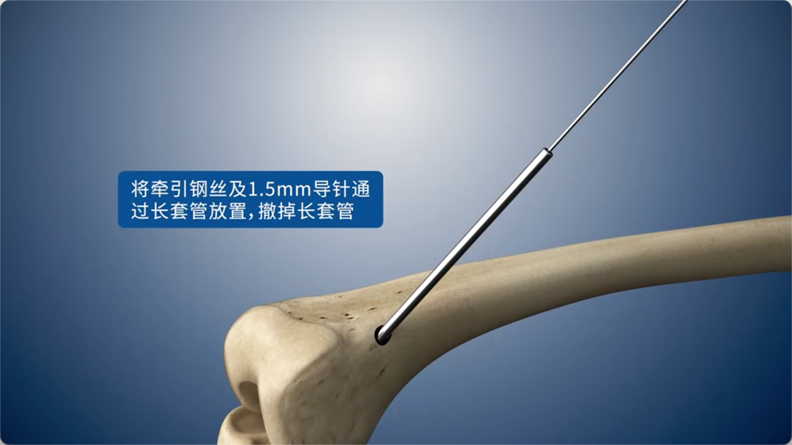 将牵引钢丝及1.5mm导针通过长套管放置，撤掉长套管