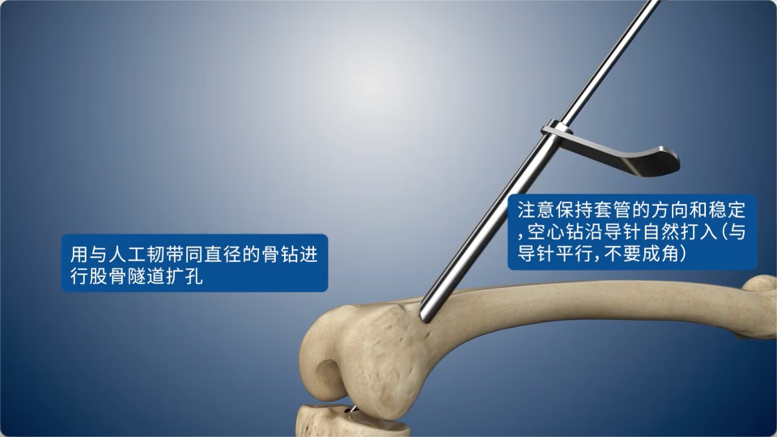 用与人工韧带同直径的骨钻进行股骨隧道扩孔