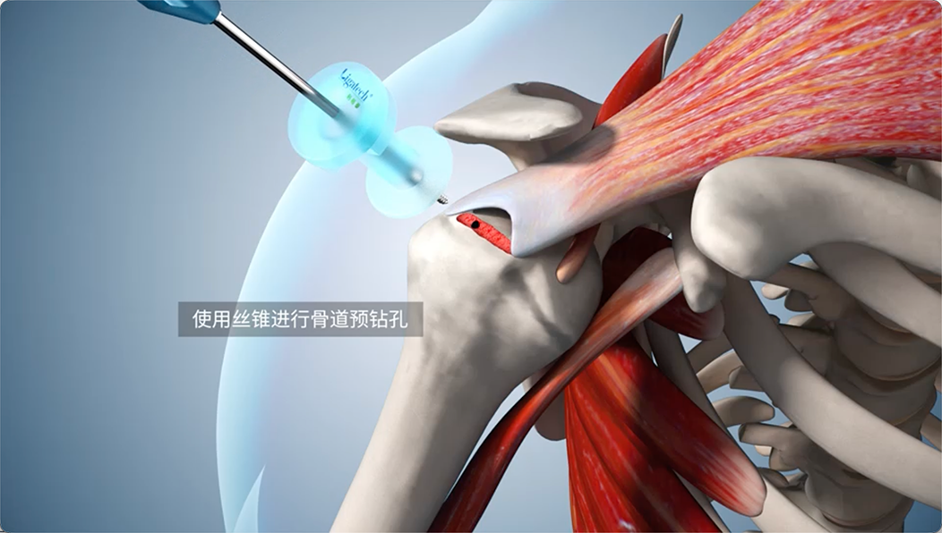 使用丝锥进行骨道预钻孔