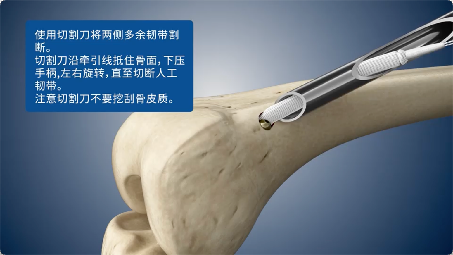 使用切割刀将两侧多余韧带割断。
切割刀沿牵引线抵住骨面，下压手柄，左右旋转，直至切断人工韧带。
注意切割刀不要挖刮骨皮质。