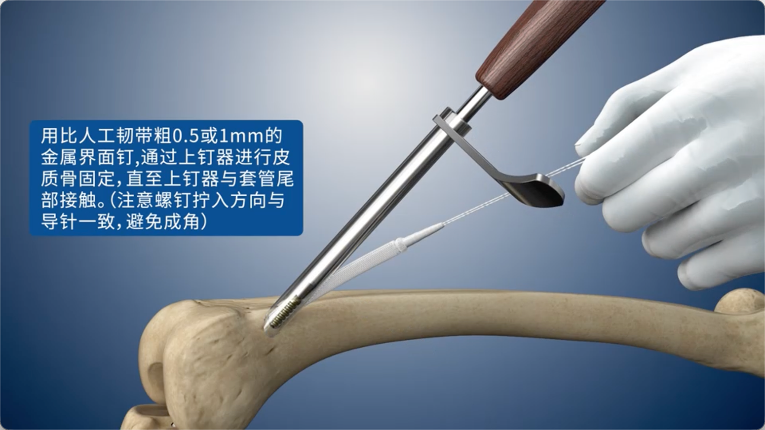 用比人工韧带粗0.5或1mm的金属界面钉，通过上钉器进行皮质骨固定，直至上钉器与套管尾部接触。（注意螺钉拧入方向与导针一致，避免成角）