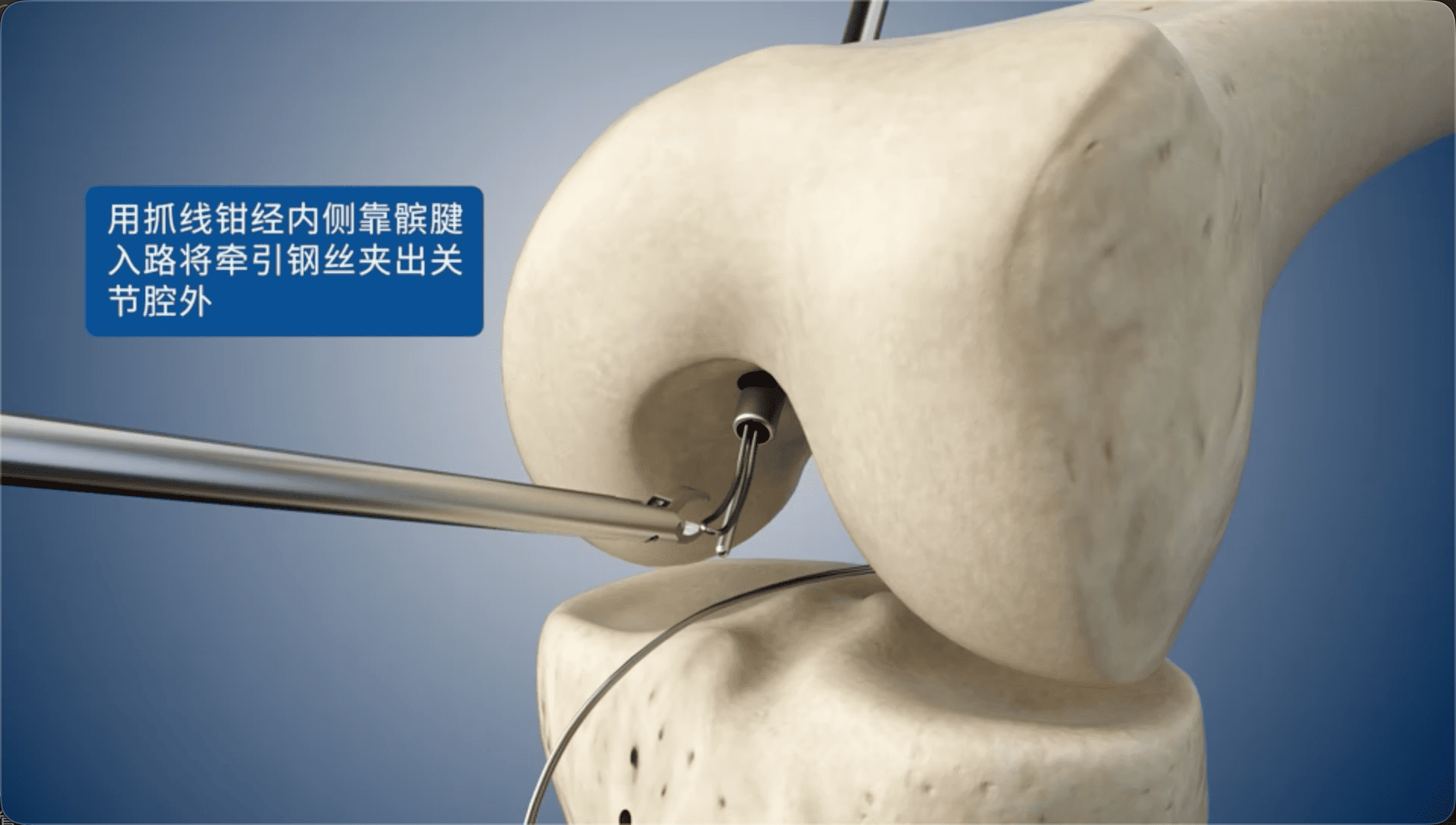 用抓线钳经内侧靠髌腱入路将牵引钢丝夹出关节腔外