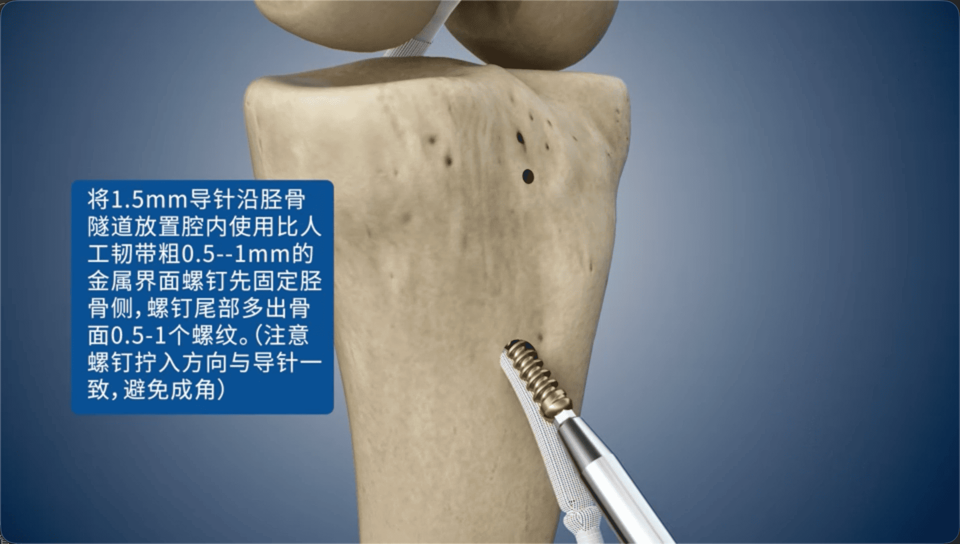将1.5mm导针沿胫骨隧道放置腔内使用比人工韧带粗0.5--1mm的金属界面螺钉先固定胫骨侧，螺钉尾部多出骨面0.5-1个螺纹。（注意螺钉拧入方向与导针一致，避免成角）