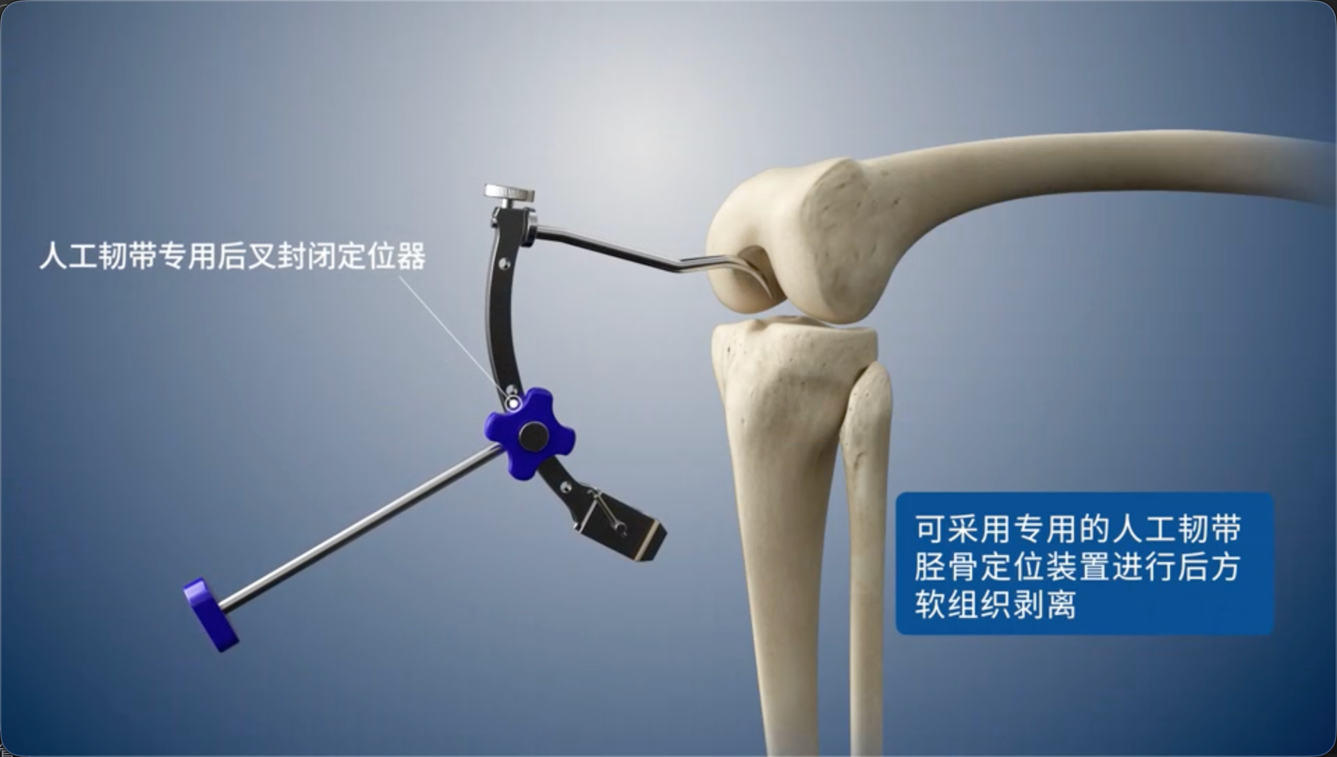 可采用专用的人工韧带胫骨定位装置进行后方软组织剥离