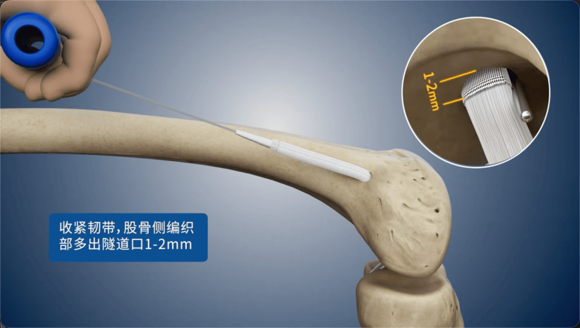 收紧韧带，股骨侧编织部多出隧道口1-2mm