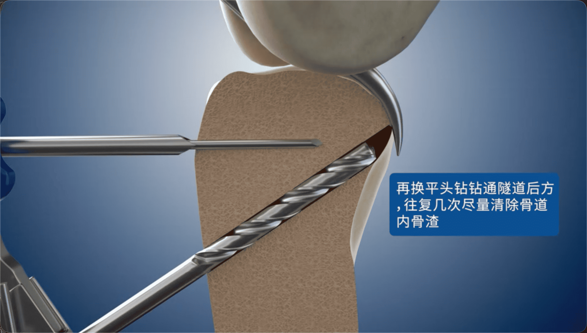 再换平头钻钻通隧道后方，往复几次尽量清除骨道内骨渣