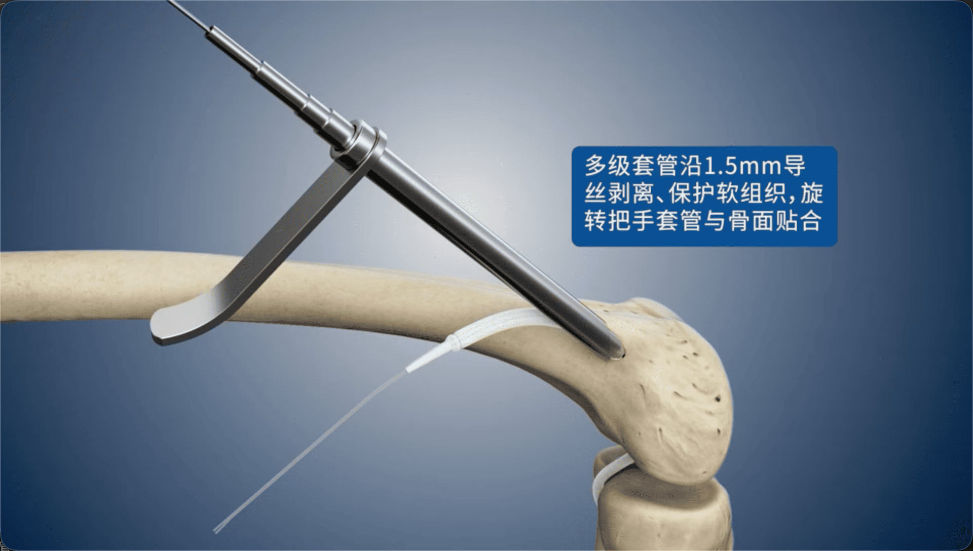 多级套管沿1.5mm导丝剥离、保护软组织，旋转把手套管与骨面贴合