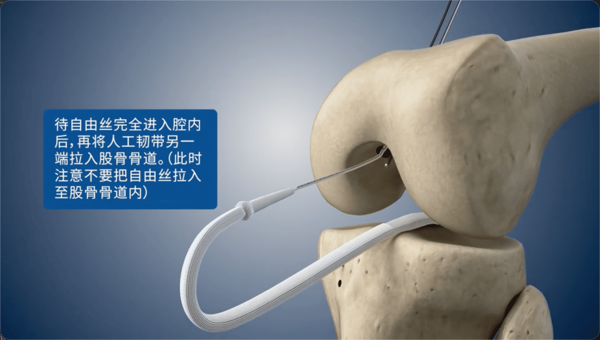 待自由丝完全进入腔内后，再将人工韧带另一端拉入股骨骨道。（此时注意不要把自由丝拉入至股骨骨道内）
