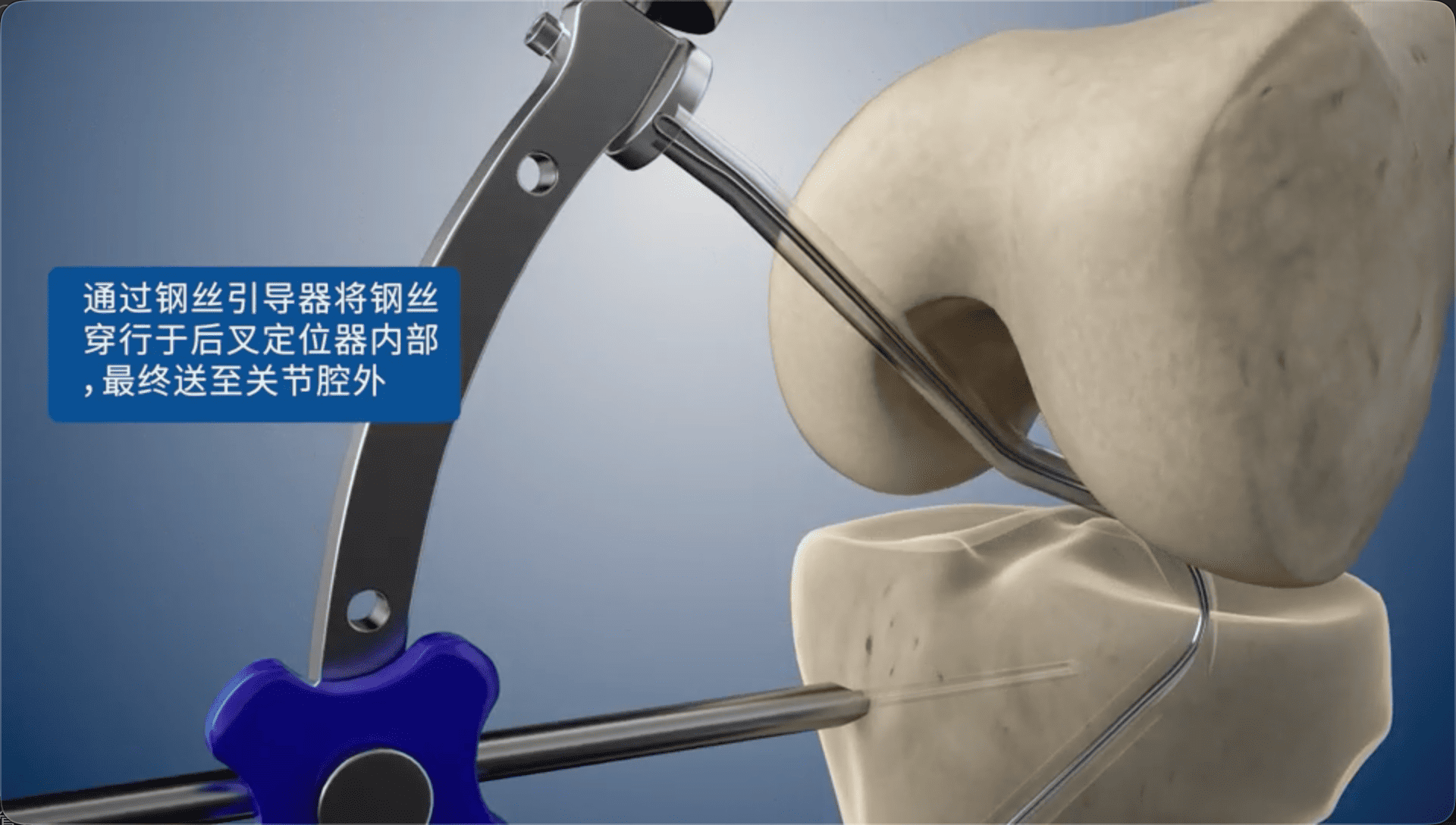 通过钢丝引导器将钢丝穿行于后叉定位器内部，最终送至关节腔外