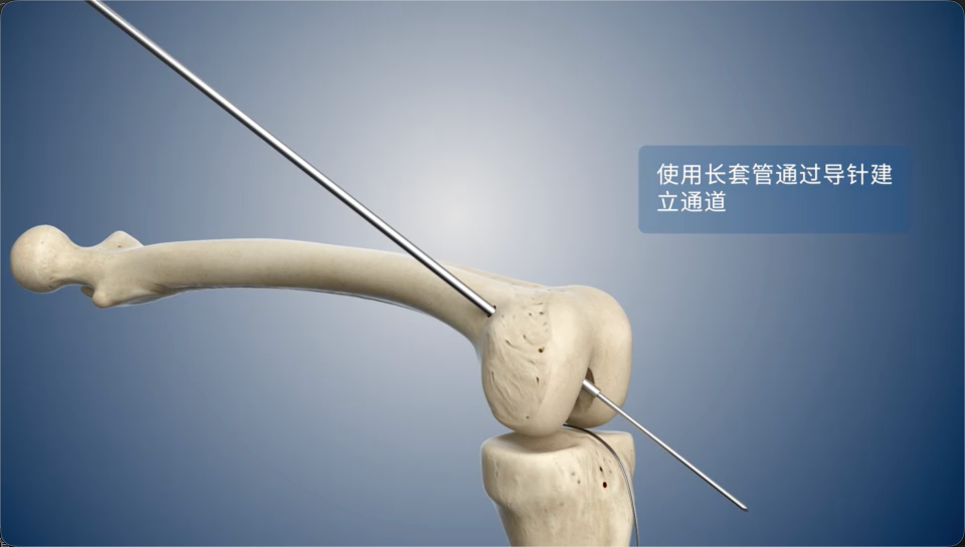 使用长套管通过导针建立通道