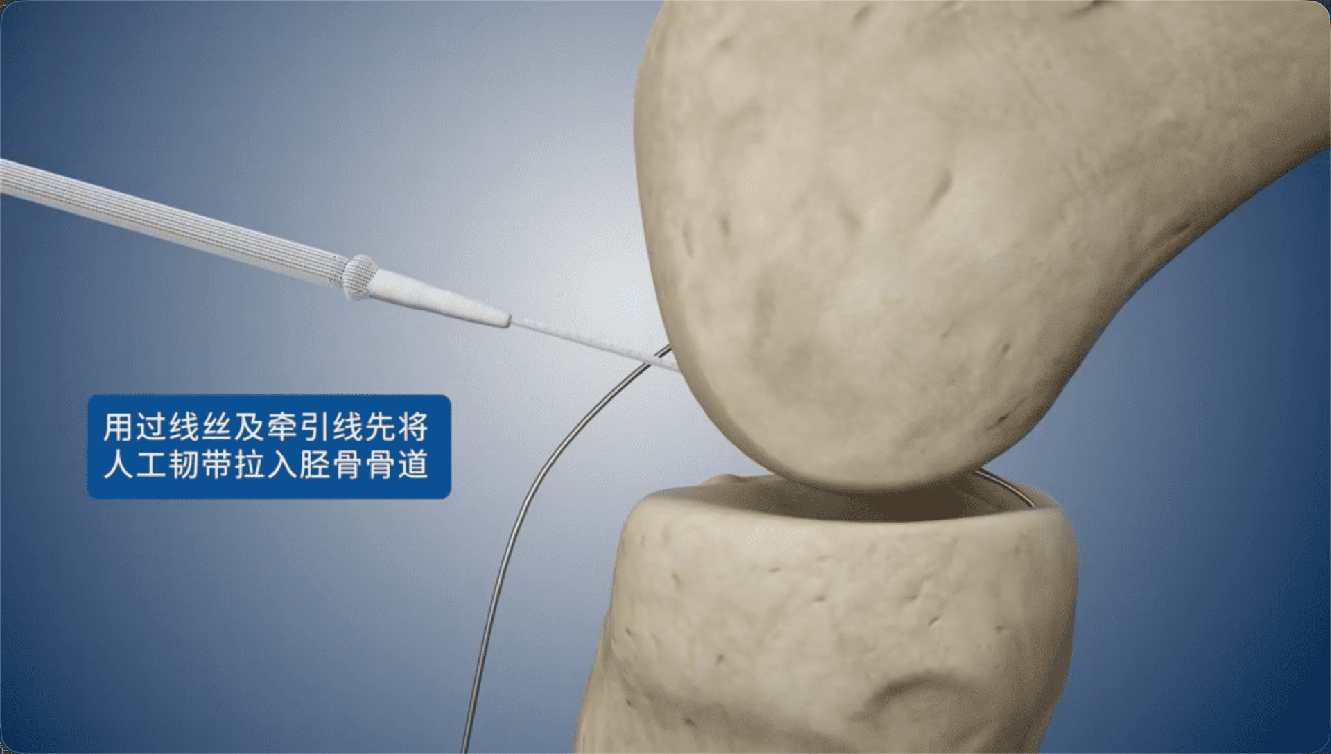 用过线丝及牵引线先将人工韧带拉入胫骨骨道