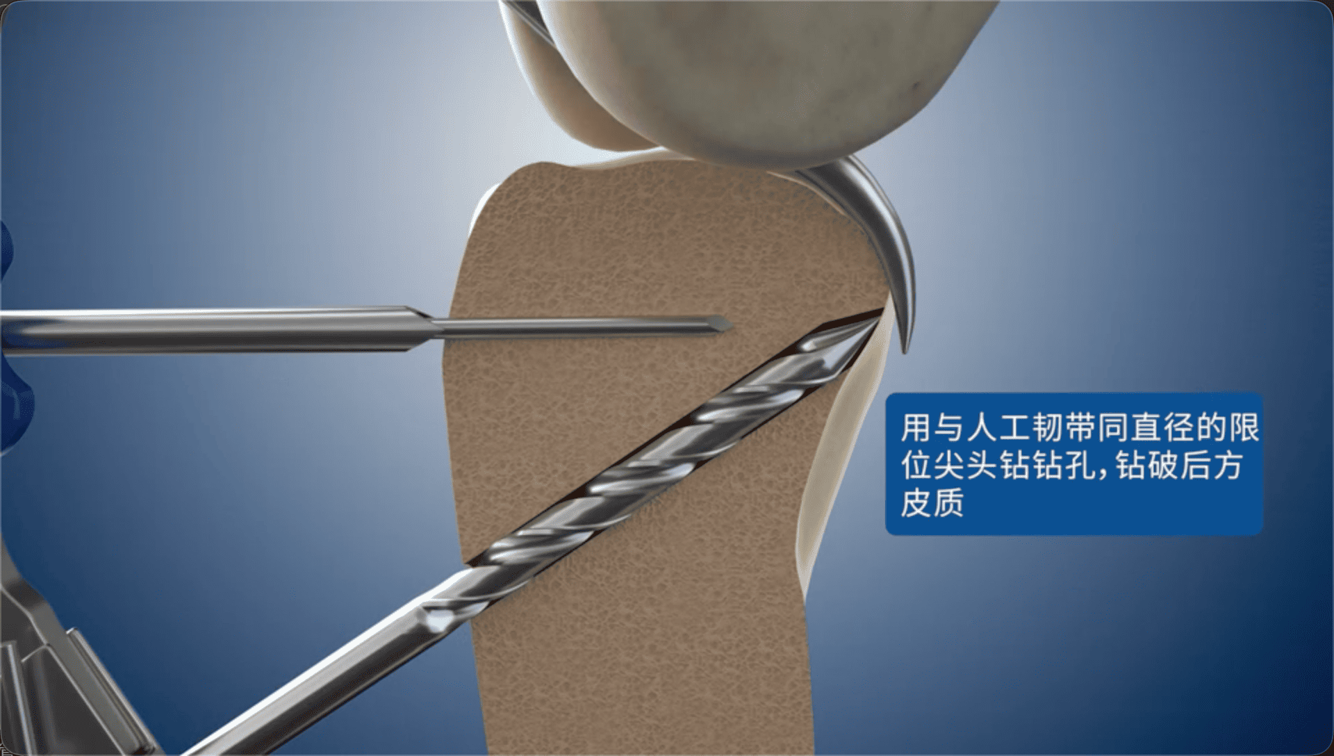 用与人工韧带同直径的限位尖头钻钻孔，钻破后方皮质