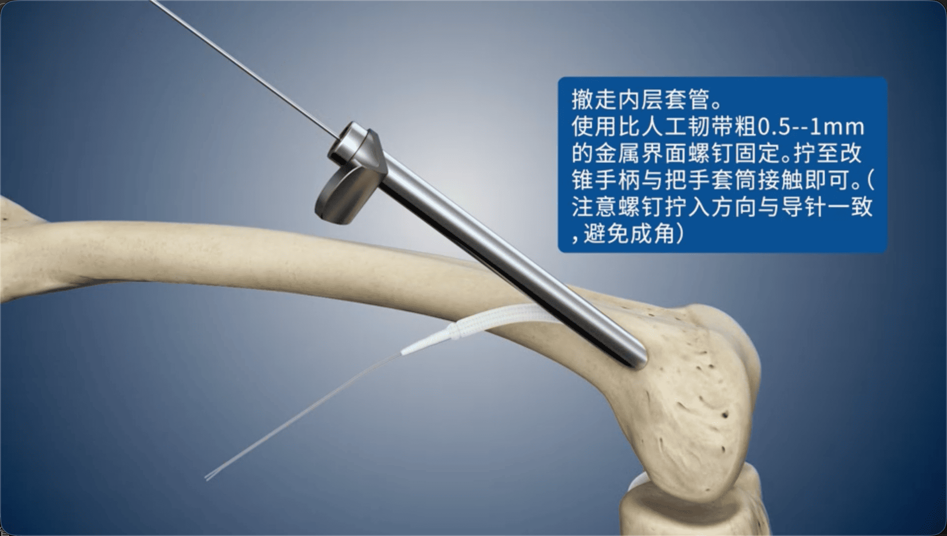 撤走内层套管。使用比人工韧带粗0.5--1mm的金属界面螺钉固定。拧至改锥手柄与把手套筒接触即可。（注意螺钉拧入方向与导针一致，避免成角）