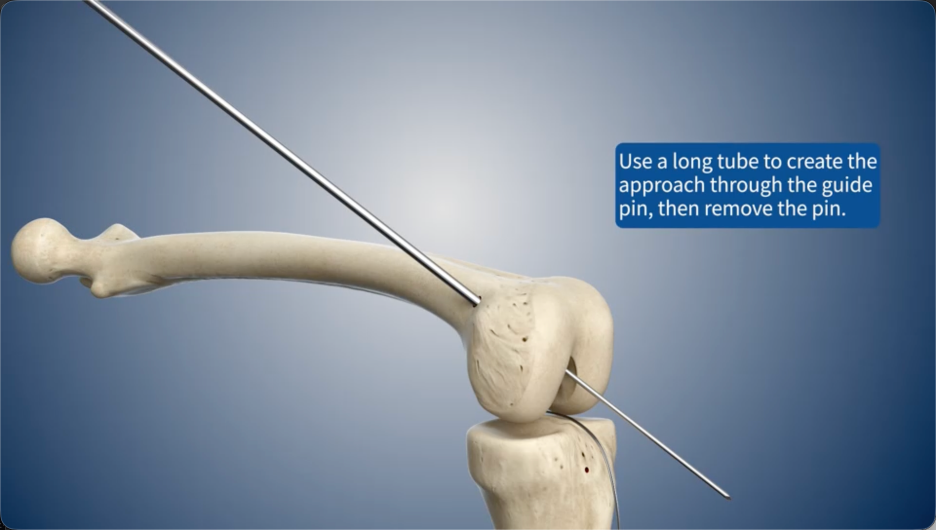 Use a long tube to create the approach through the guide pin, then remove the pin.