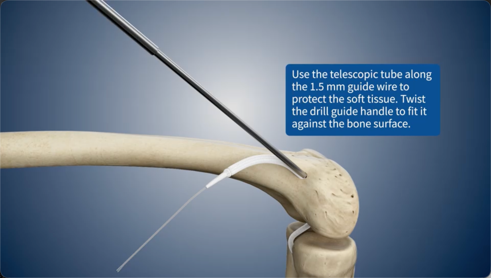 Use the telescopic tube along the 1.5 mm guide wire to protect the soft tissue. Twist the drill guide handle to fit it against the bone surface.