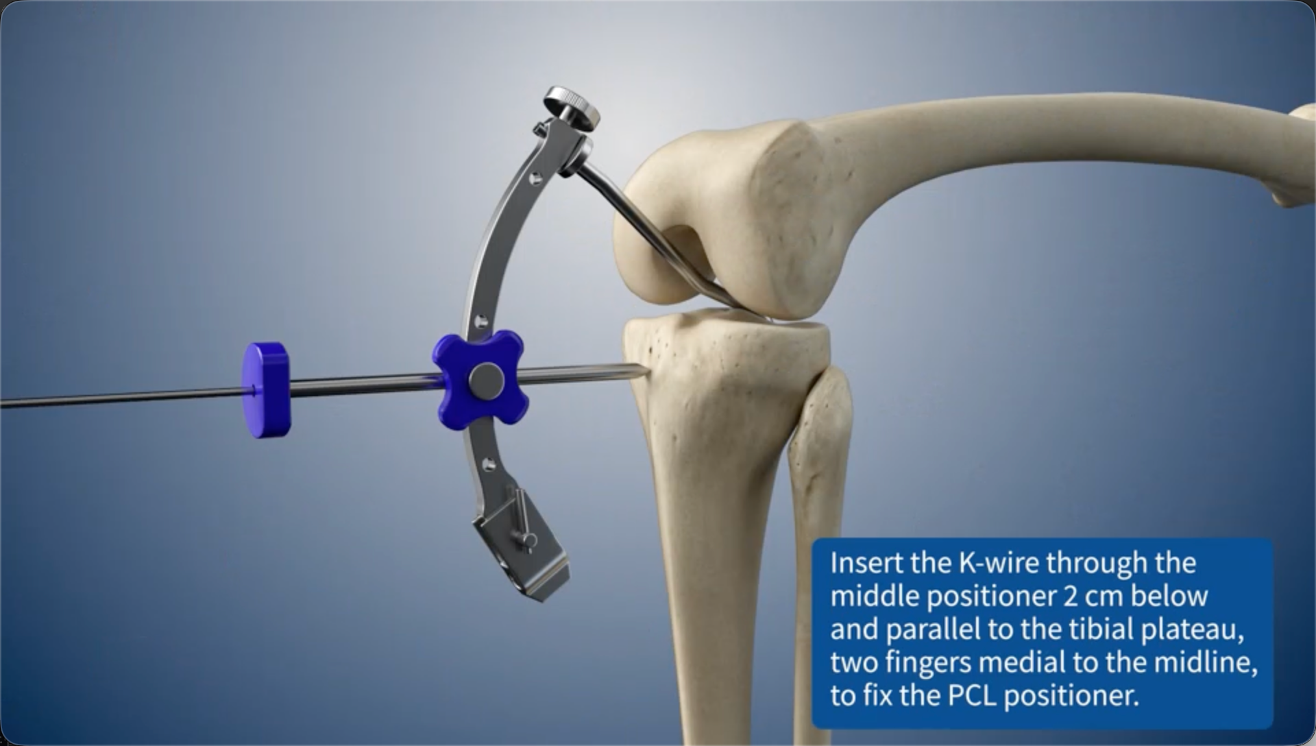 Insert the K-wire through the middle positioner 2 cm below and parallel to the tibial plateau, two fingers medial to the midline, to fix the PCL positioner.
