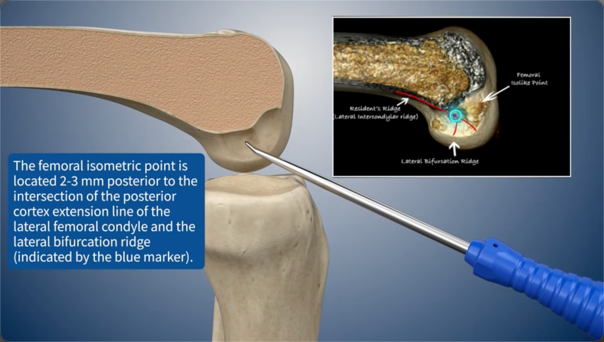 The femoral isometric point is located 2-3 mm posterior to the intersection of the posterior cortex extension line of the lateral femoral condyle and the lateral bifurcation ridge (indicated by the blue marker).