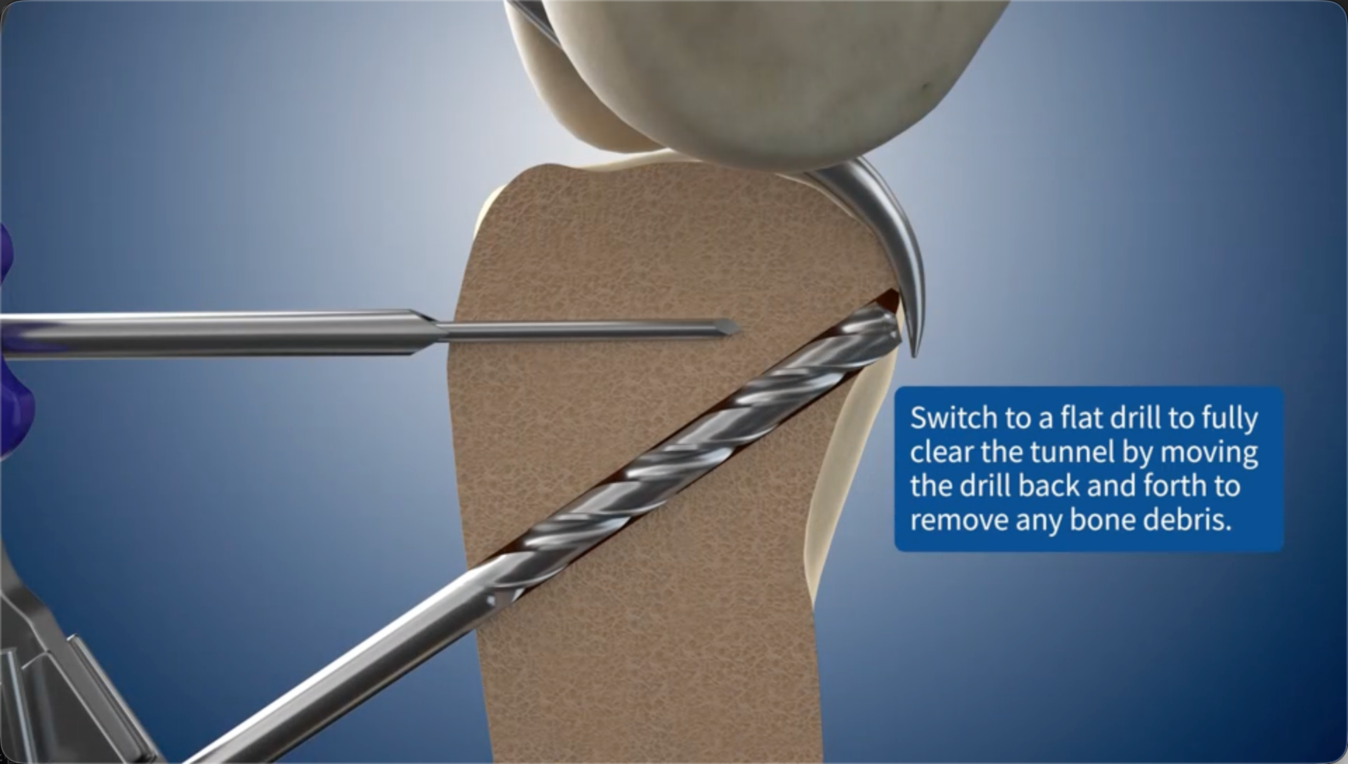 Switch to a flat drill to fully clear the bone tunnel by moving the drill back and forth to remove any bone debris.