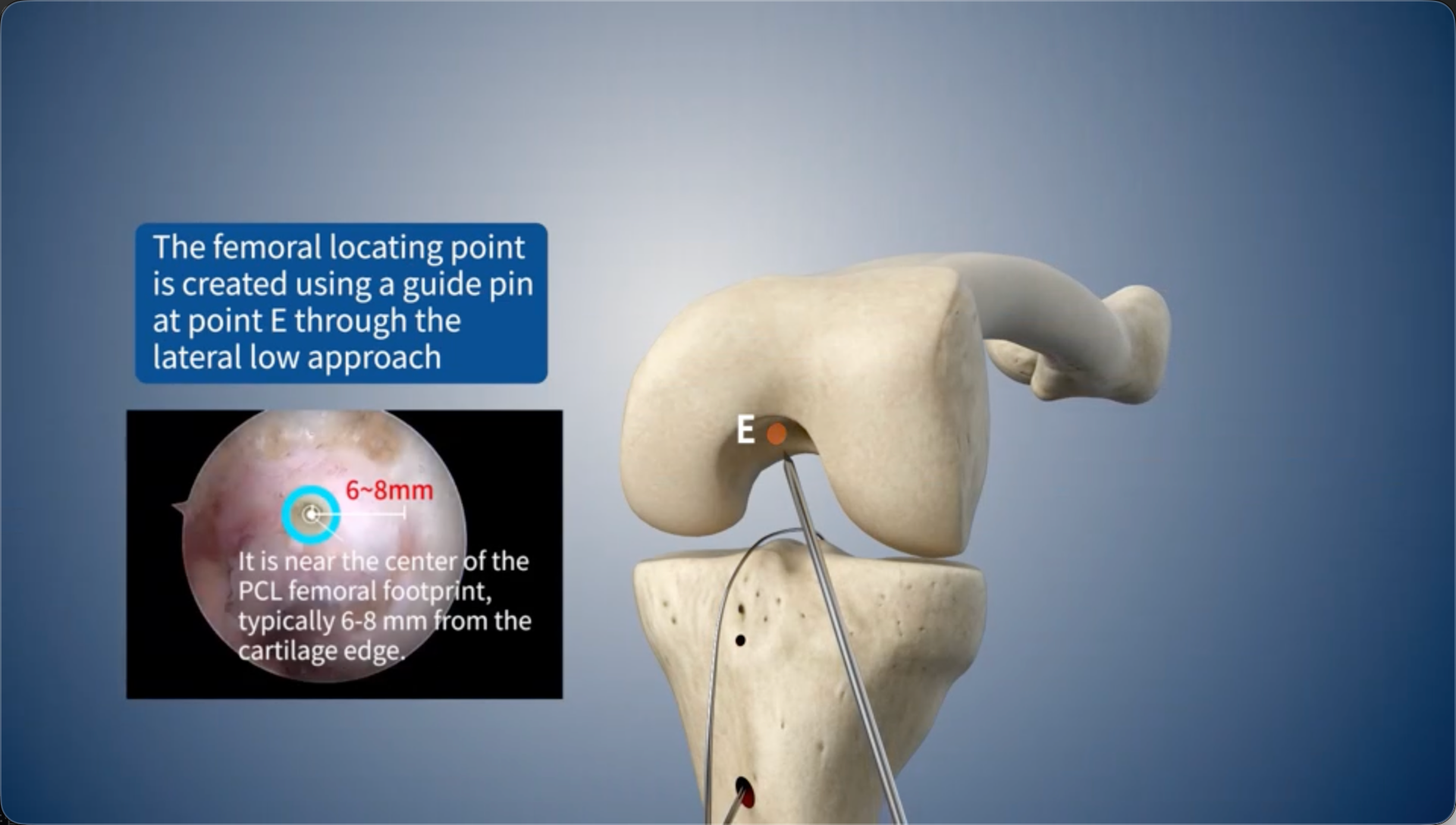 The femoral locating point is created using a guide pin at point E through the lateral low approach