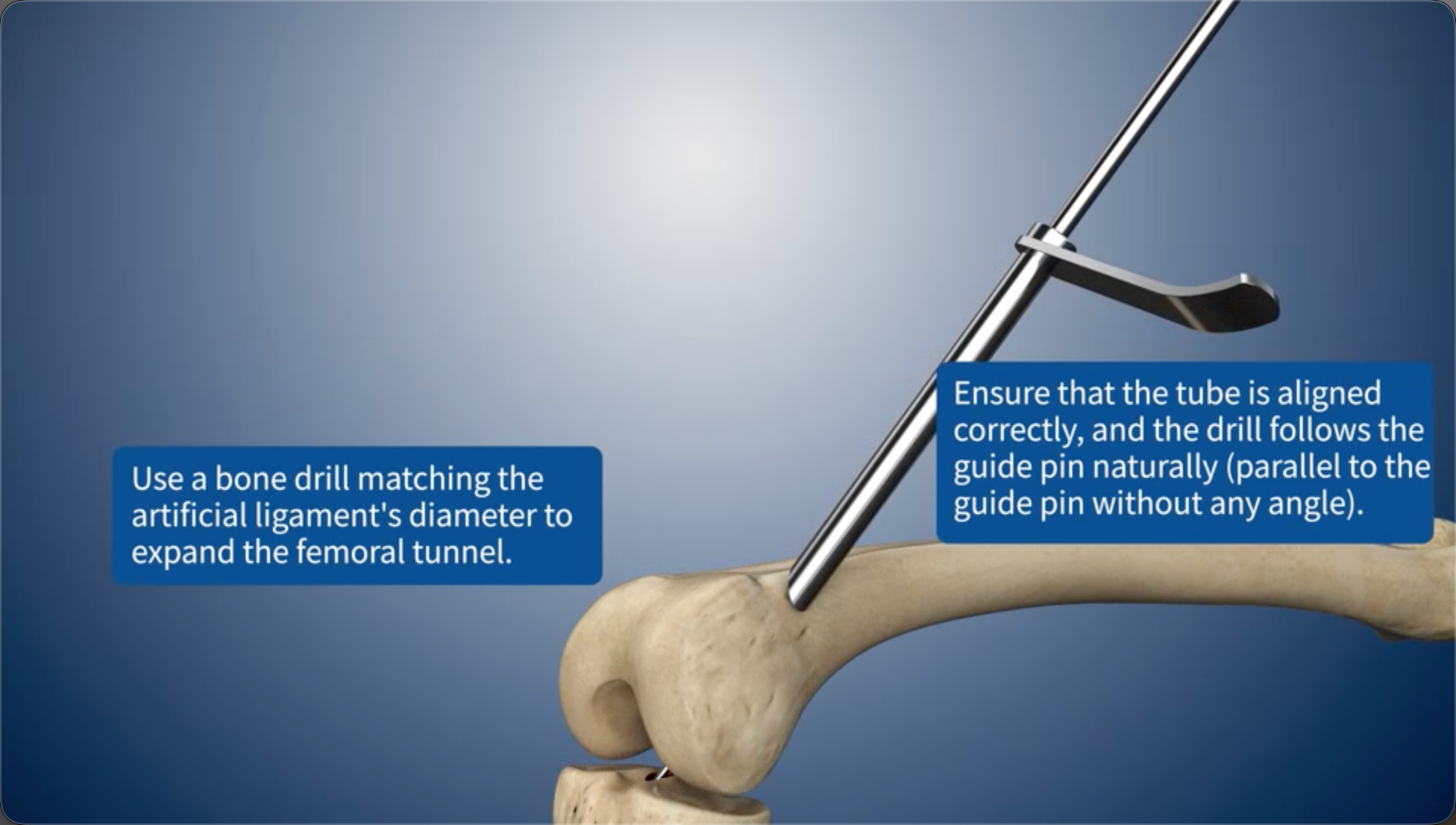 Use a bone drill matching the artificial ligament's diameter to expand the femoral bone tunnel.Ensure that the tube is aligned correctly, and the drill follows the guide pin naturally (parallel to the guide pin without any angle).