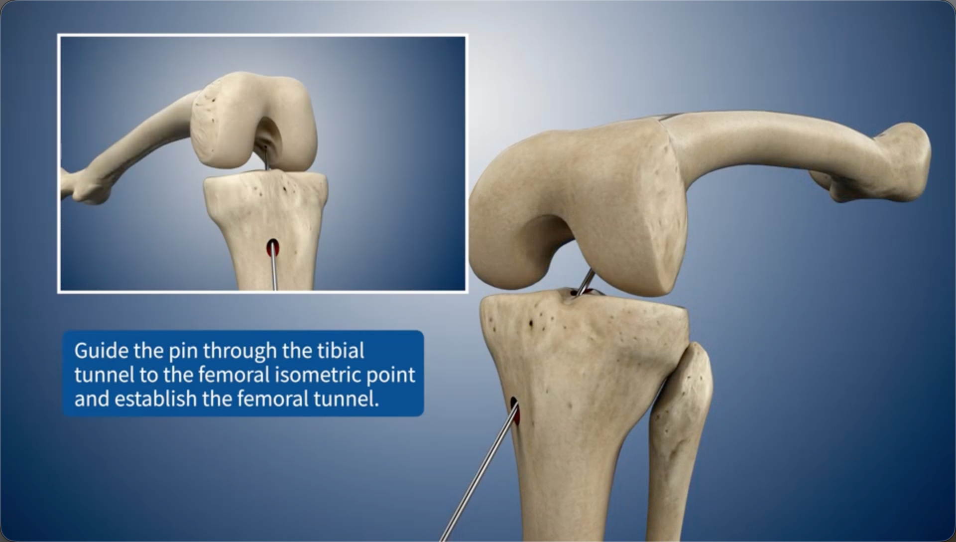 Guide the pin through the tibial bone tunnel to the femoral isometric point and establish the femoral bone tunnel.