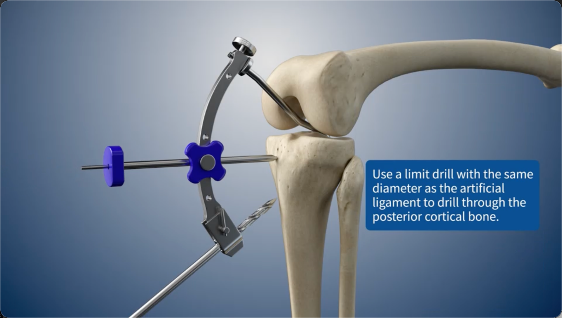 Use a limit drill with the same diameter as the artificial ligament to drill through the posterior cortical bone.