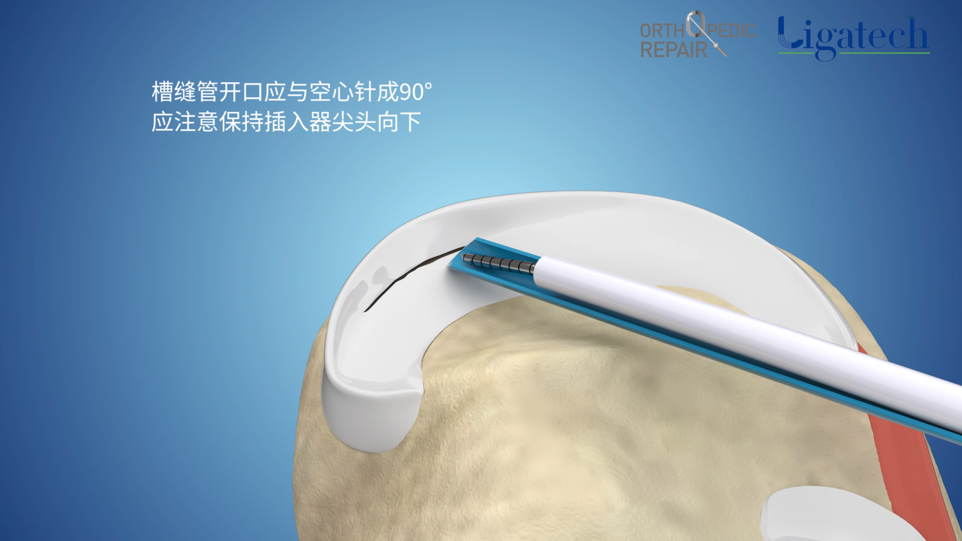 槽缝管开口应与空心针成90°应注意保持插入器尖头向下
