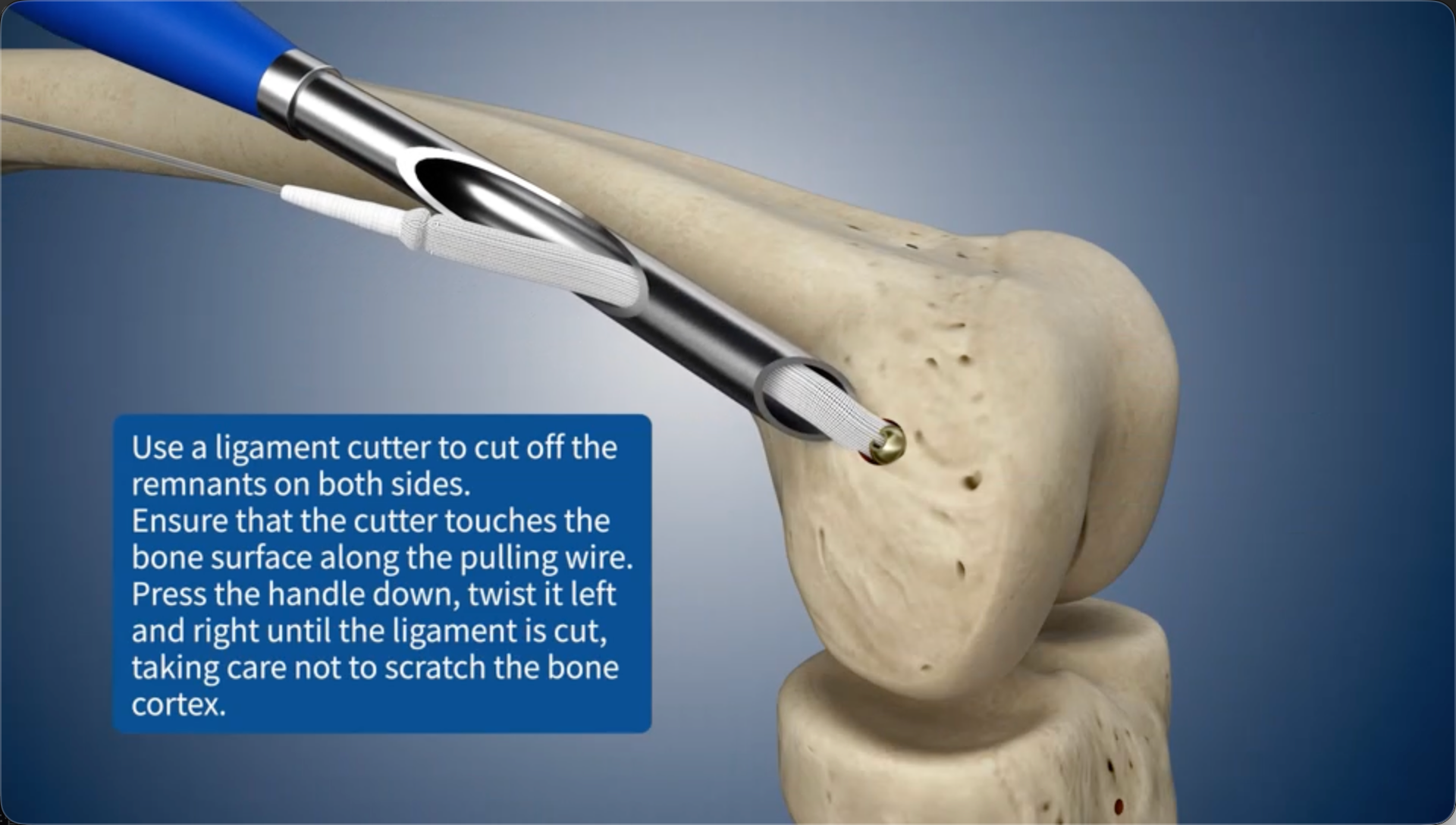 Use a ligament cutter to cut off the remnants on both sides.Ensure that the cutter touches the bone surface along the pulling wire. Press the handle down, twist it left and right until the ligament is cut, taking care not to scratch the bone cortex.