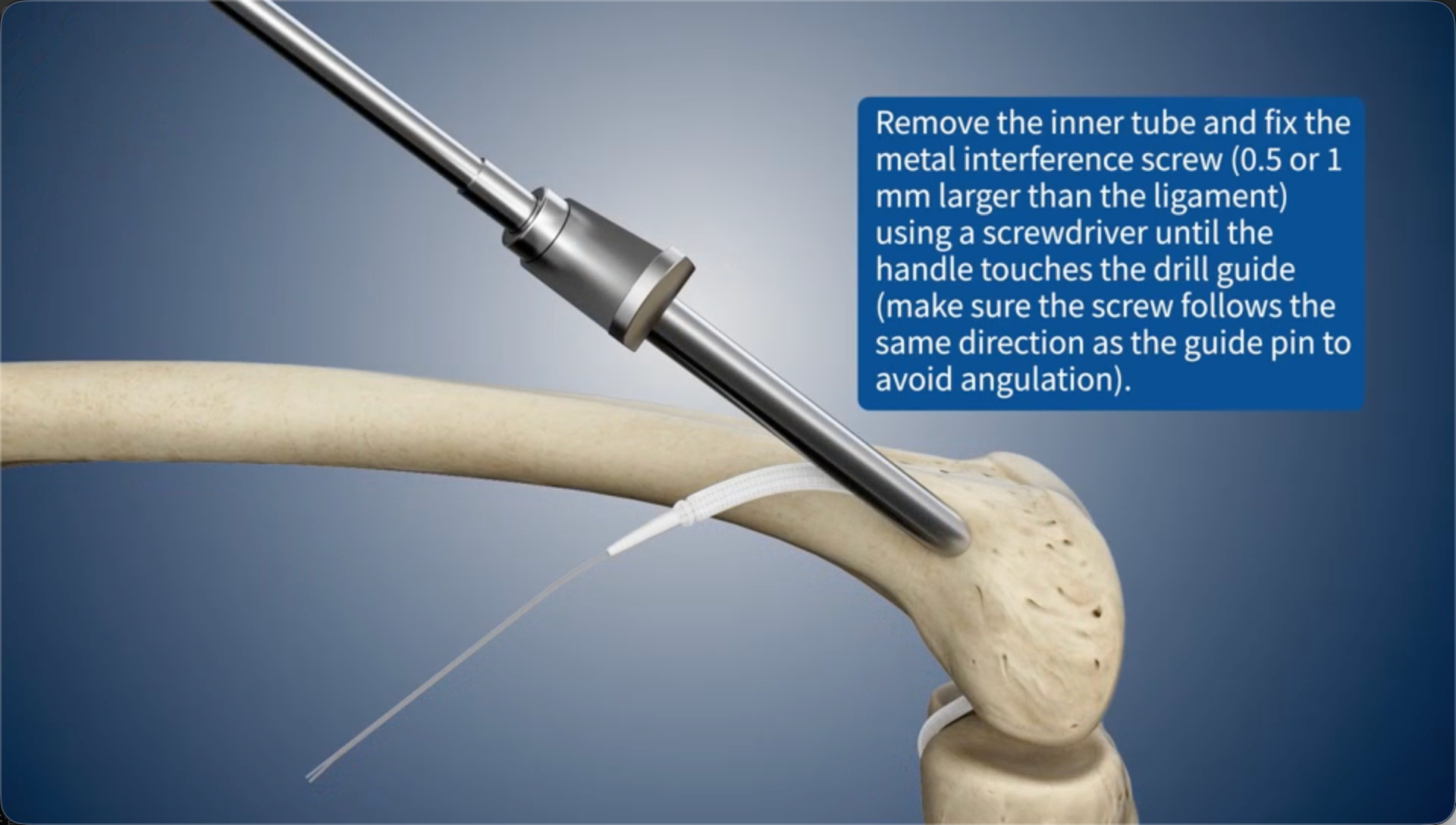 Remove the inner tube and fix the metal interference screw (0.5 or 1 mm larger than the ligament) using a screwdriver until the handle touches the drill guide (make sure the screw follows the same direction as the guide pin to avoid angulation).