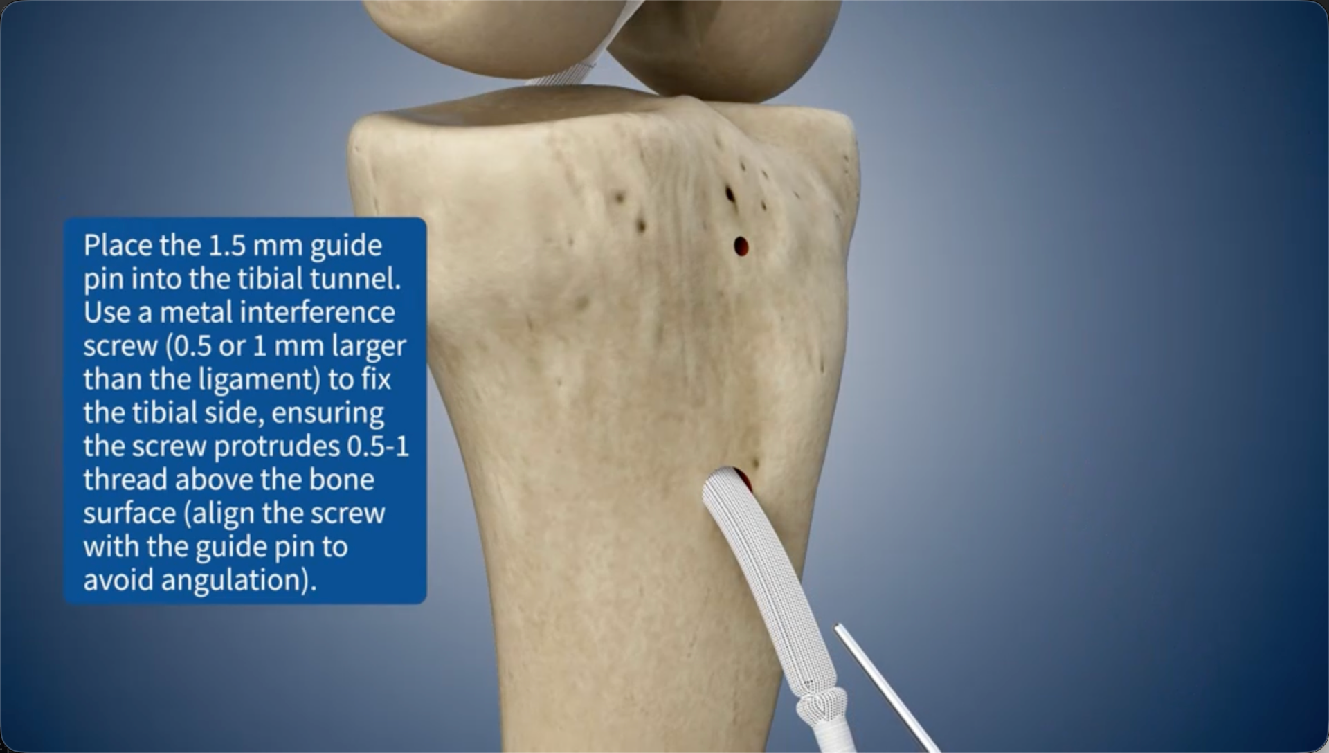 Place the 1.5 mm guide pin into the tibial bone tunnel. Use a metal interference screw (0.5 or 1 mm larger than the ligament) to fix the tibial side, ensuring the screw protrudes 0.5-1 thread above the bone surface (align the screw with the guide pin to avoid angulation).