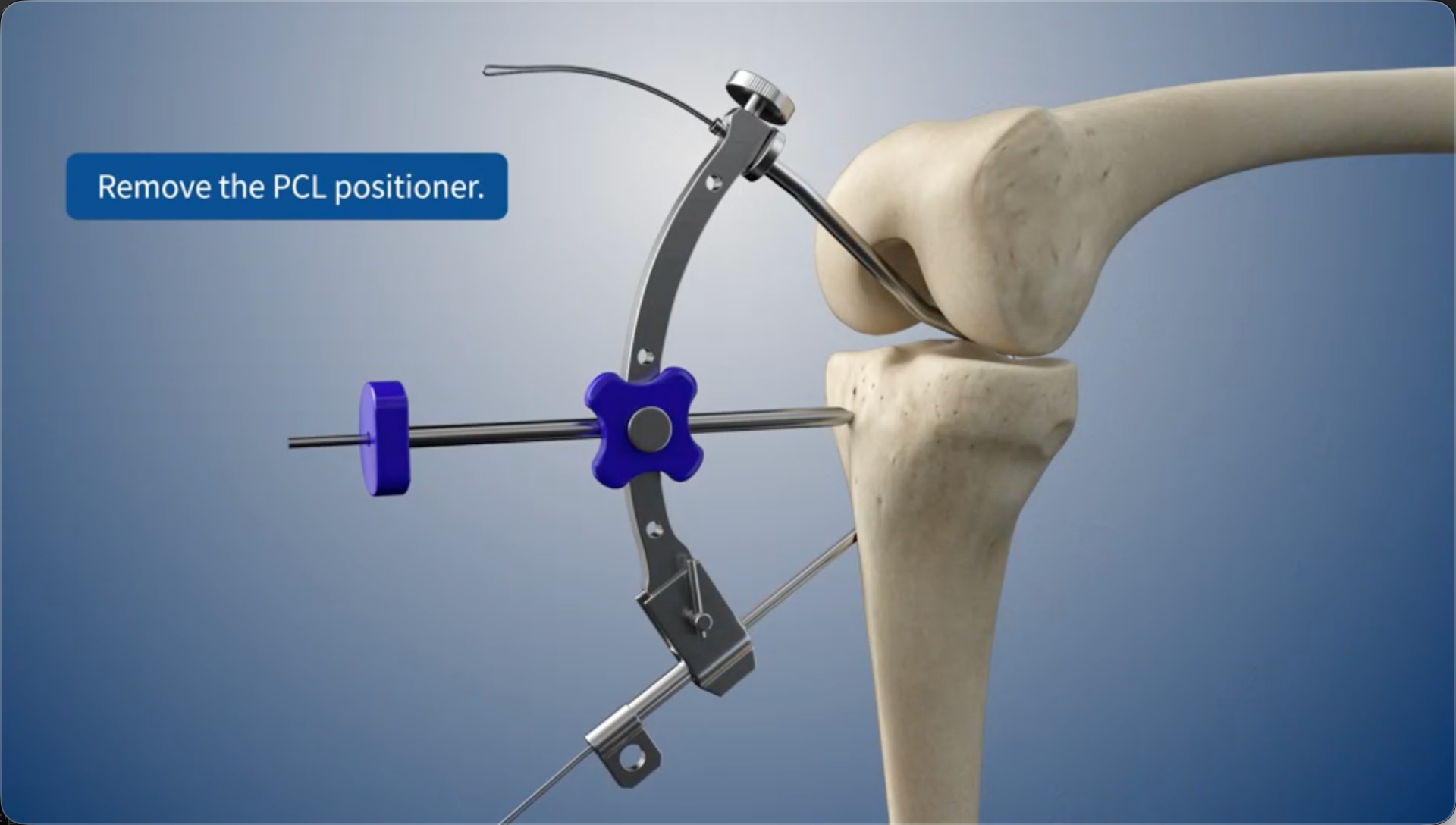 Remove the PCL positioner.