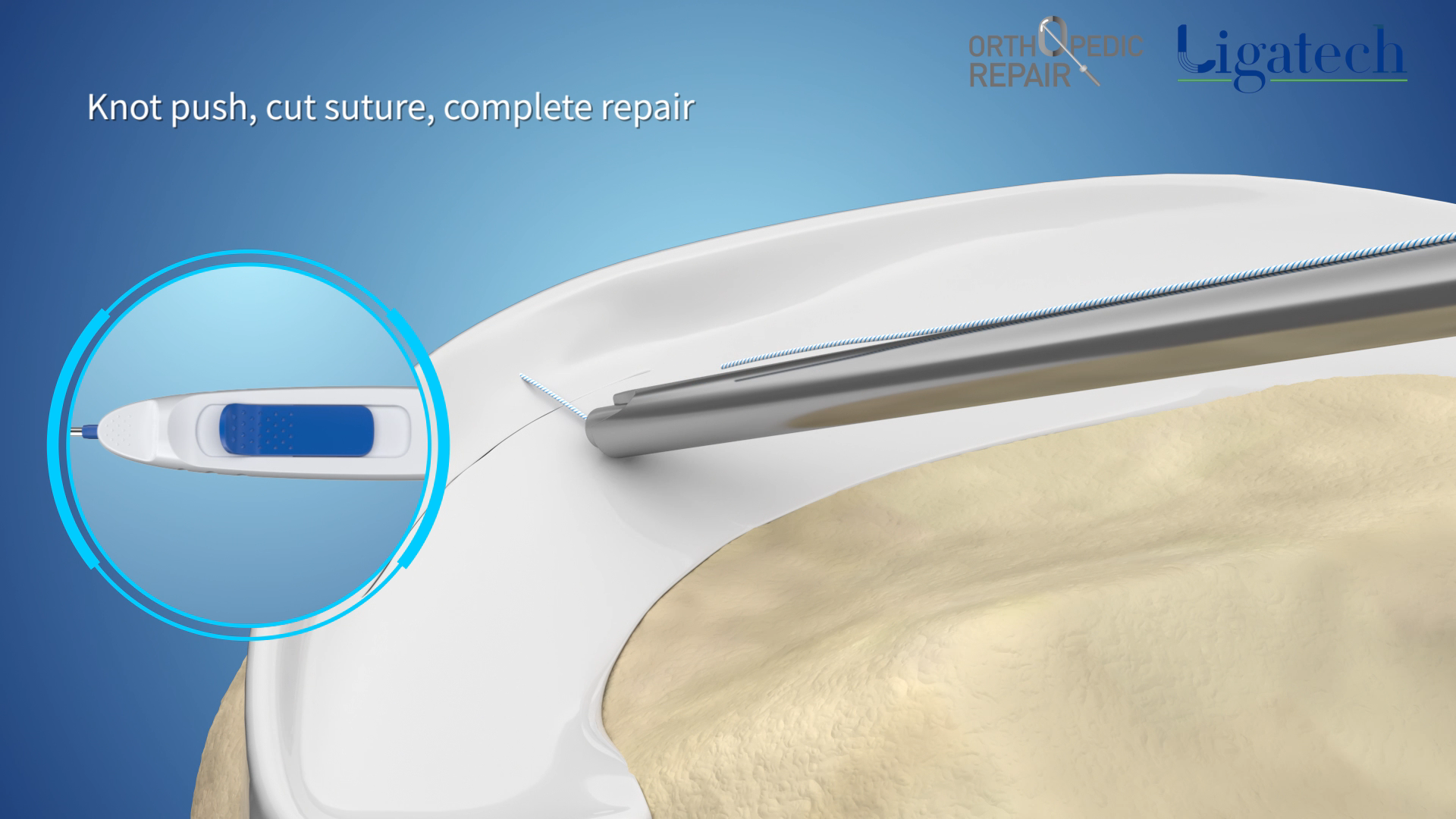 Knot push, cut suture, complete repair
