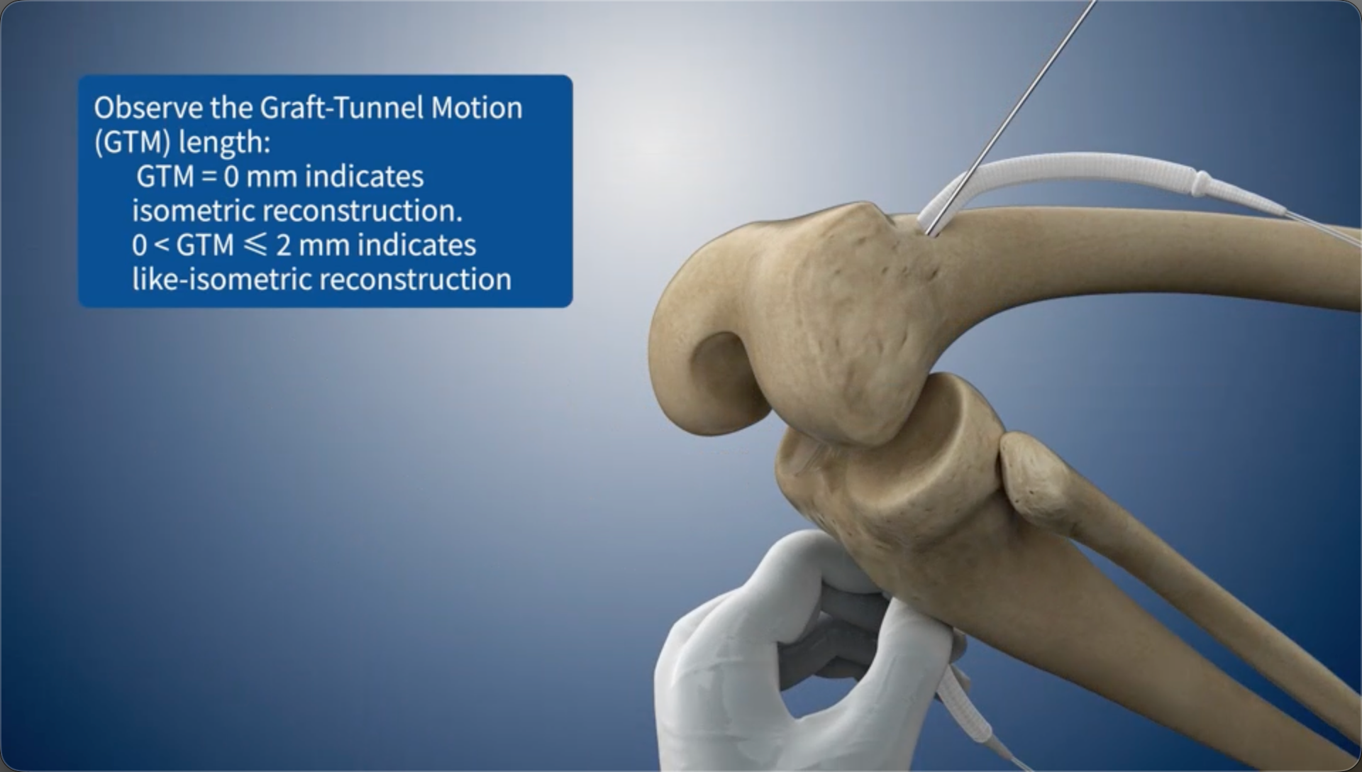 Observe the Graft-Tunnel Motion (GTM) length:GTM = 0 mm indicates isometric reconstruction.0 < GTM ≤ 2 mm indicates like-isometric reconstruction