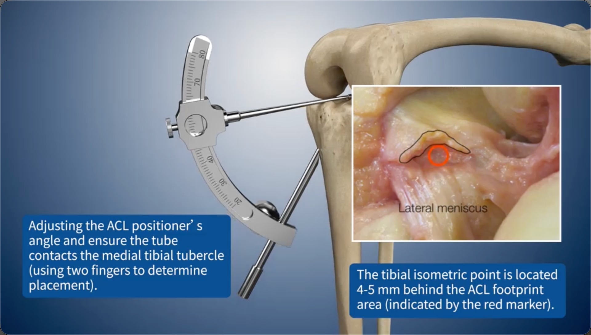 Adjusting the ACL positioner's angle and ensure the tube contacts the medial tibial tubercle (using two fingers to determine placement).The tibial isometric point is located 4-5 mm behind the ACL footprint area (indicated by the red marker).