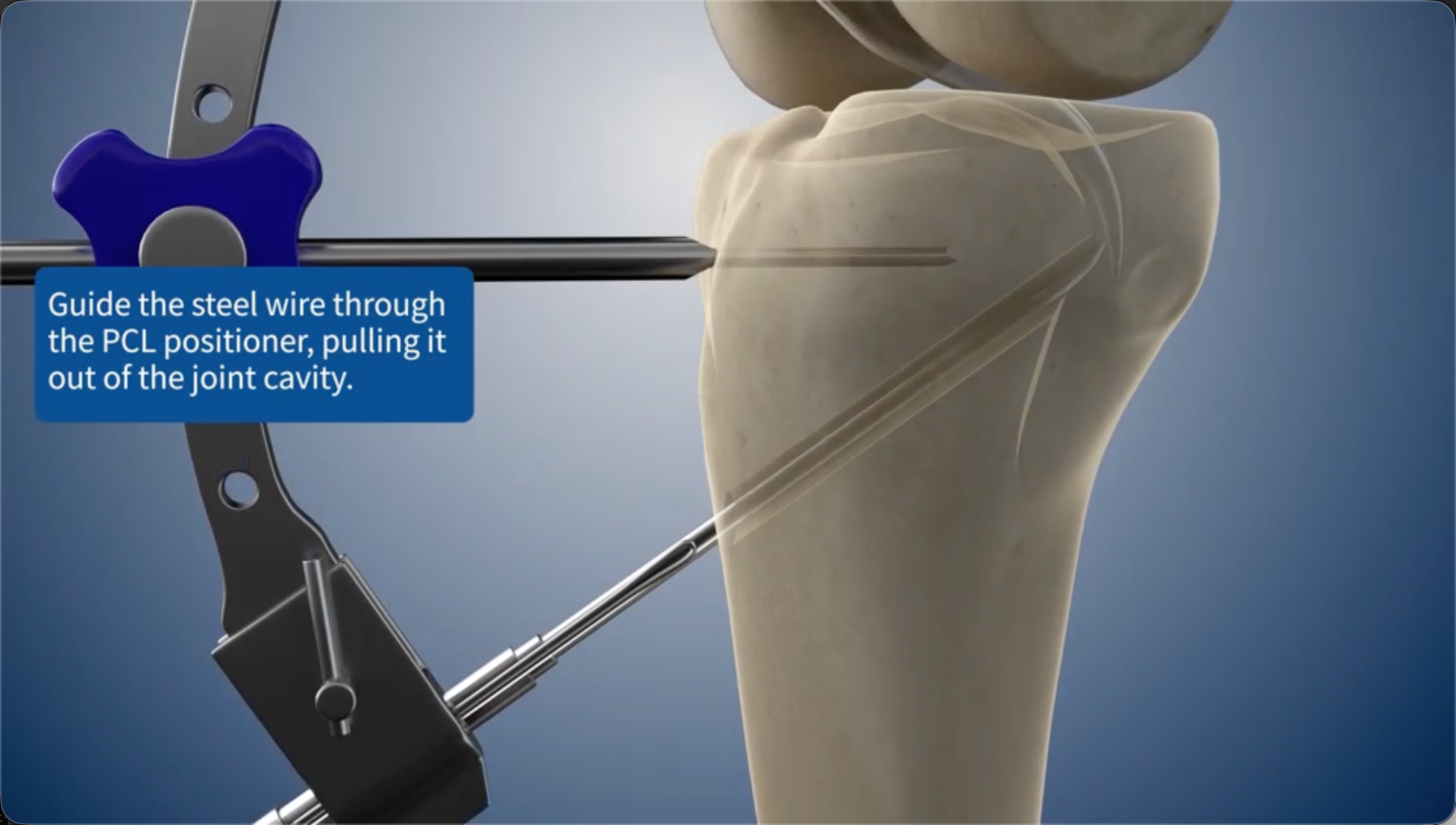 Guide the steel wire through the PCL positioner, pulling it out of the joint cavity.