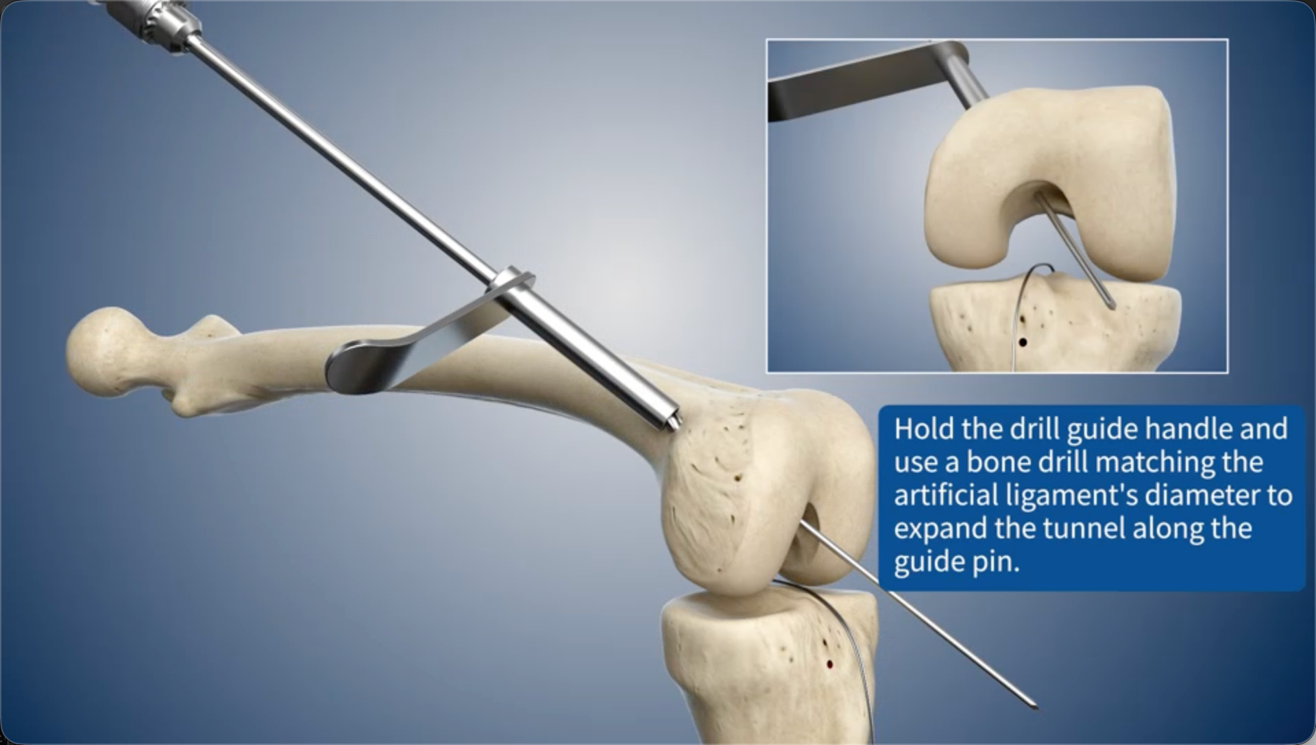 Hold the drill guide handle and use a bone drill matching the artificial ligament's diameter to expand the bone tunnel along the guide pin.