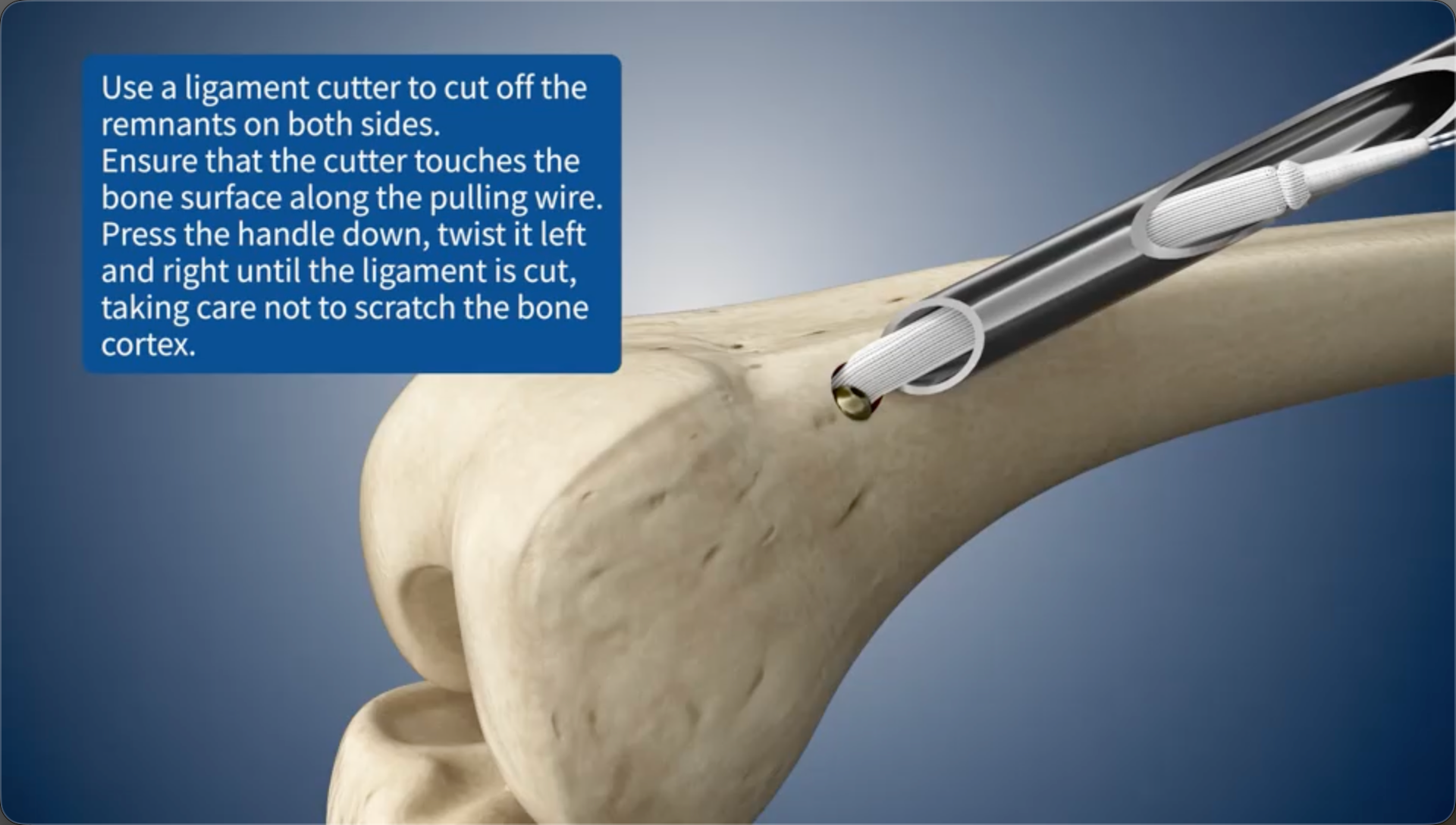 Use a ligament cutter to cut off the remnants on both sides.Ensure that the cutter touches the bone surface along the pulling wire. Press the handle down, twist it left and right until the ligament is cut, taking care not to scratch the bone cortex.