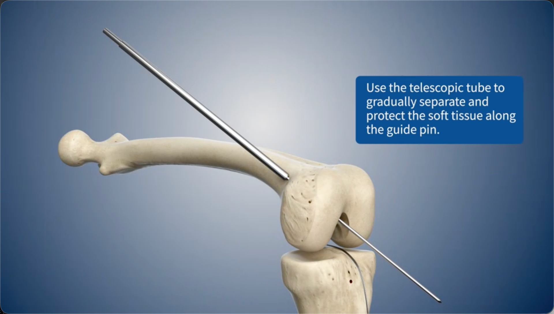 Use the telescopic tube to gradually separate and protect the soft tissue along the guide pin.