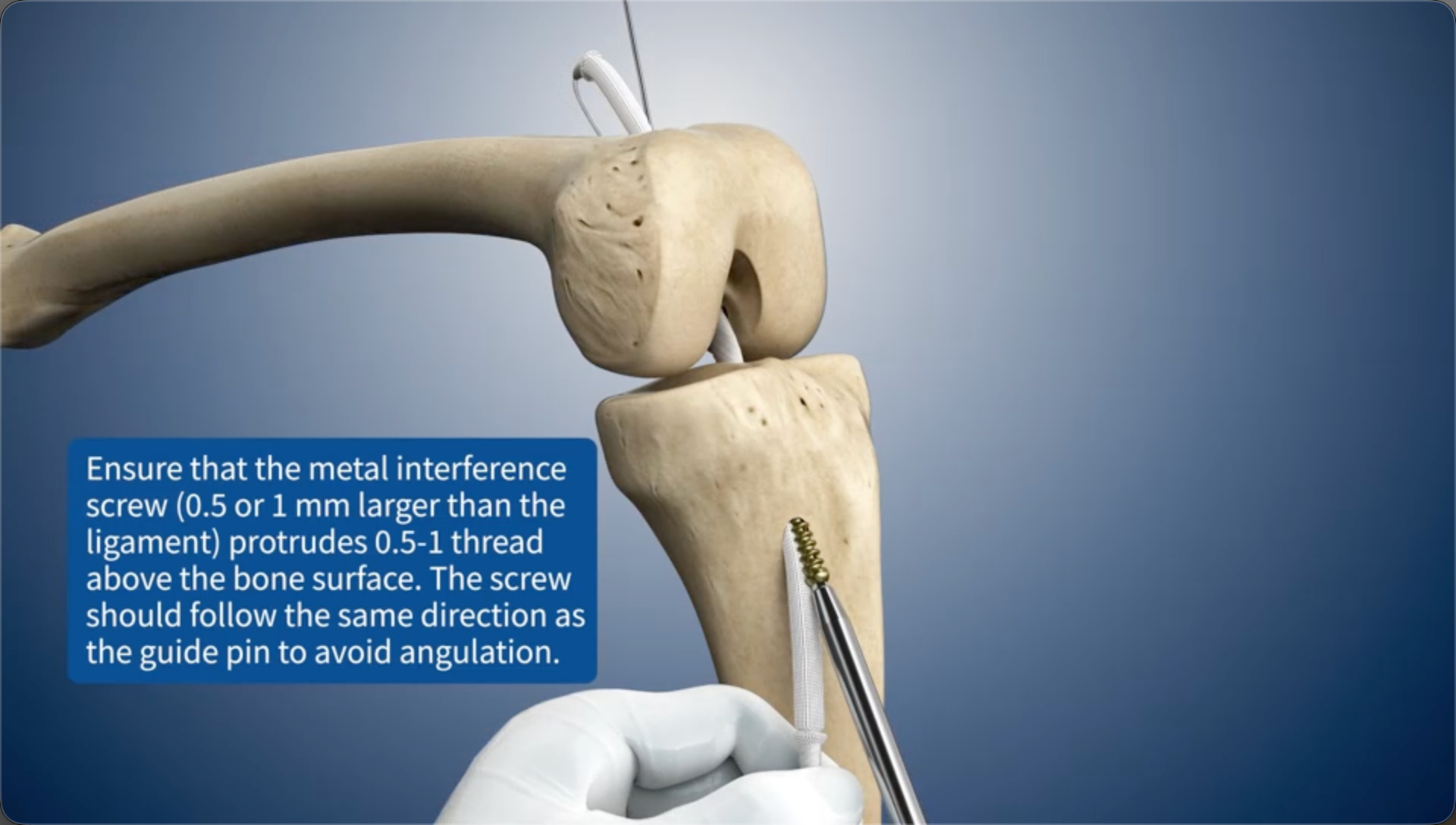 Ensure that the metal interference screw (0.5 or 1 mm larger than the ligament) protrudes 0.5-1 thread above the bone surface. The screw should follow the same direction as the guide pin to avoid angulation.