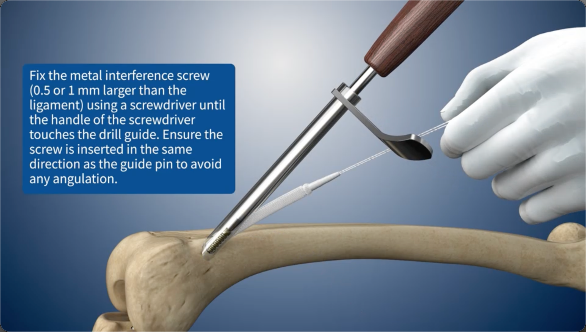 Fix the metal interference screw (0.5 or 1 mm larger than the ligament) using a screwdriver until the handle of the screwdriver touches the drill guide. Ensure the screw is inserted in the same direction as the guide pin to avoid any angulation.