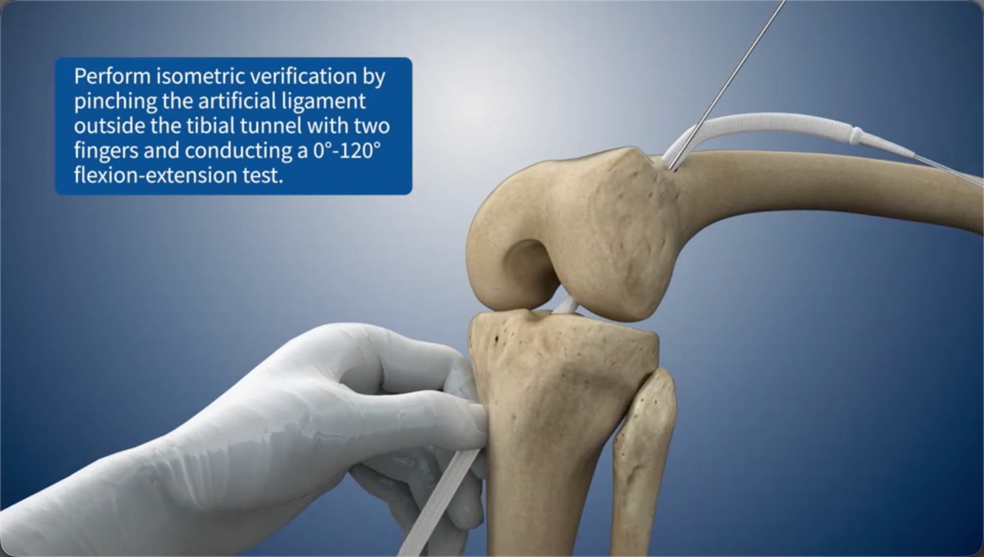 Perform isometric verification by pinching the artificial ligament outside the tibial bone tunnel with two fingers and conducting a 0°-120° flexion-extension test.